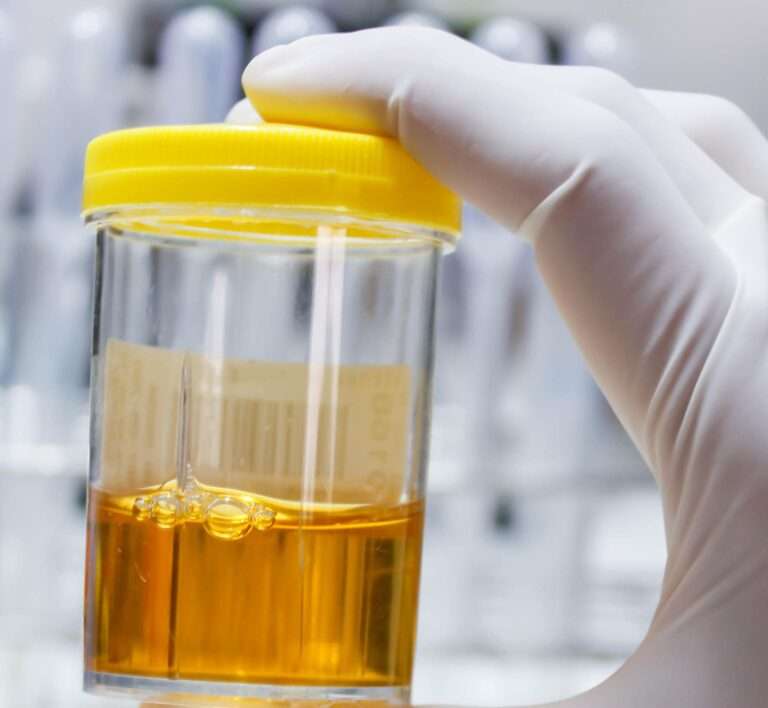 Urine specimen in cup